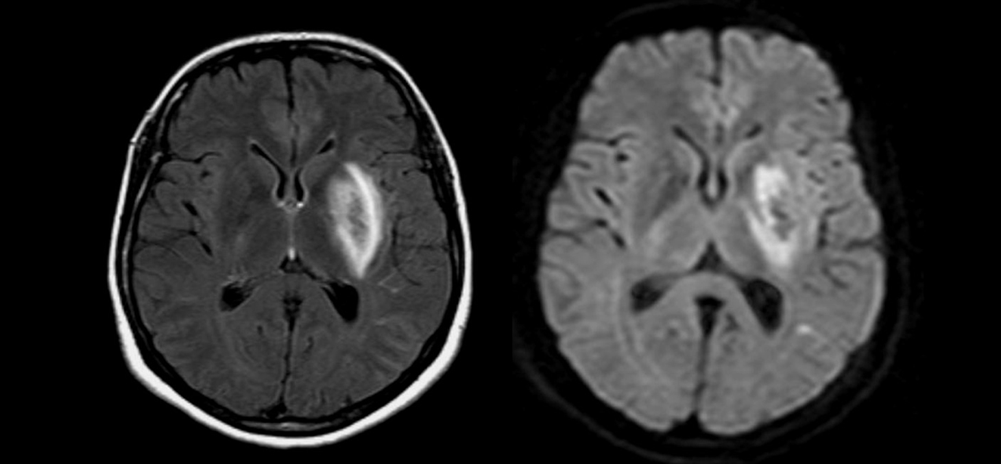 Lésion causée par un accident vasculaire cérébral observée par IRM